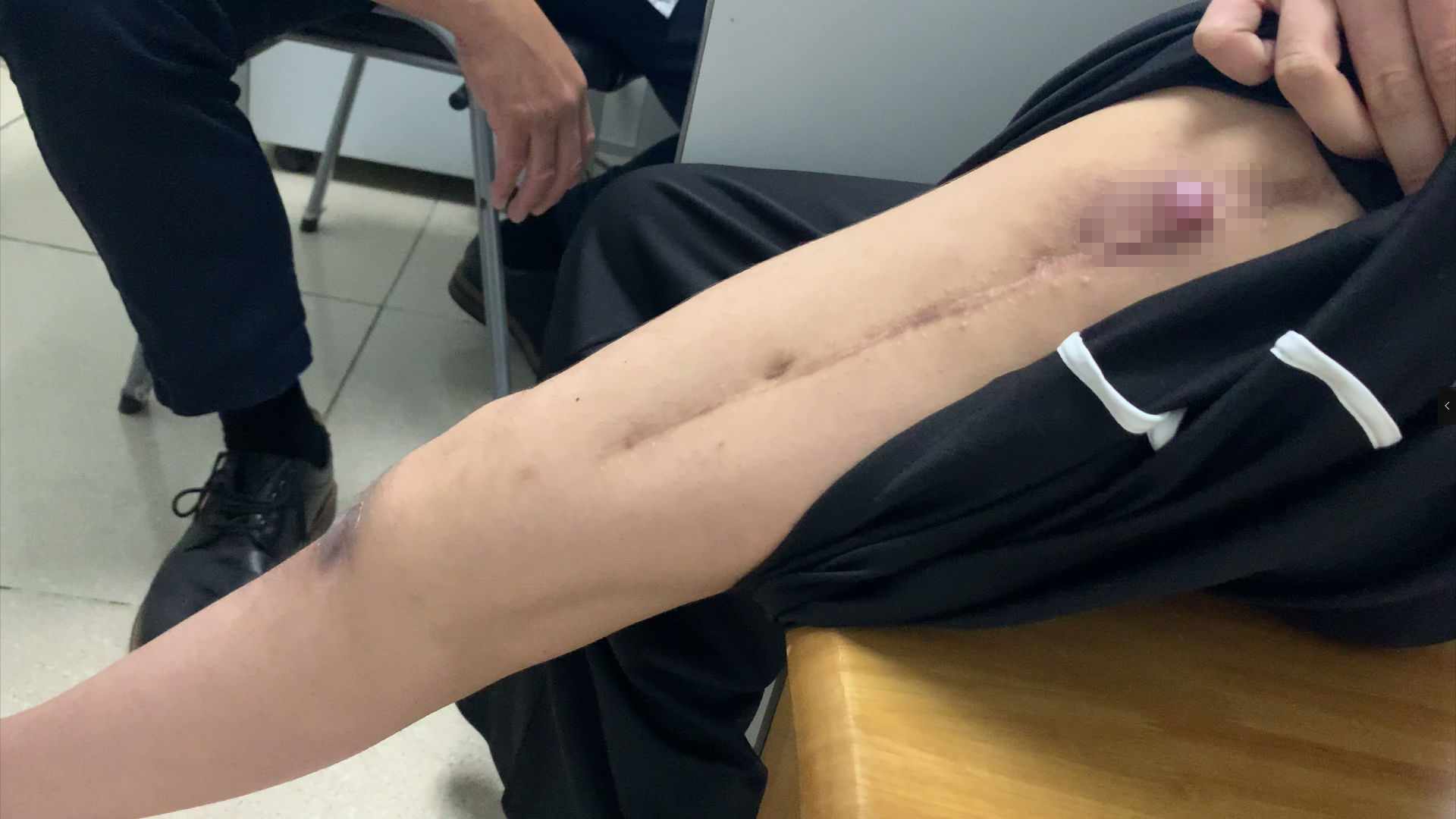 骨癌手术后，假体感染，不想截肢还能怎么办？有4个可行方法