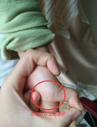 什么是小儿狭窄性腱鞘炎？要怎样康复呢？