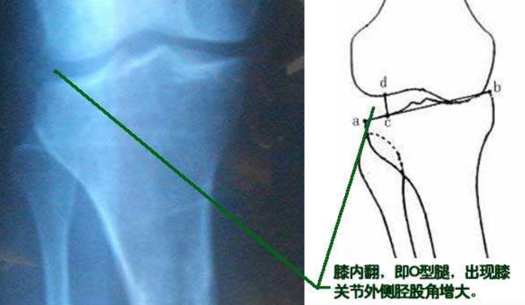 nba有哪些o型腿(詹姆斯也是O型腿，为什么他膝关节不疼，而我打篮球就腿痛呢？)