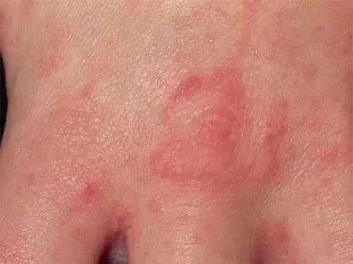 十三,疥疮(scabies)见下图