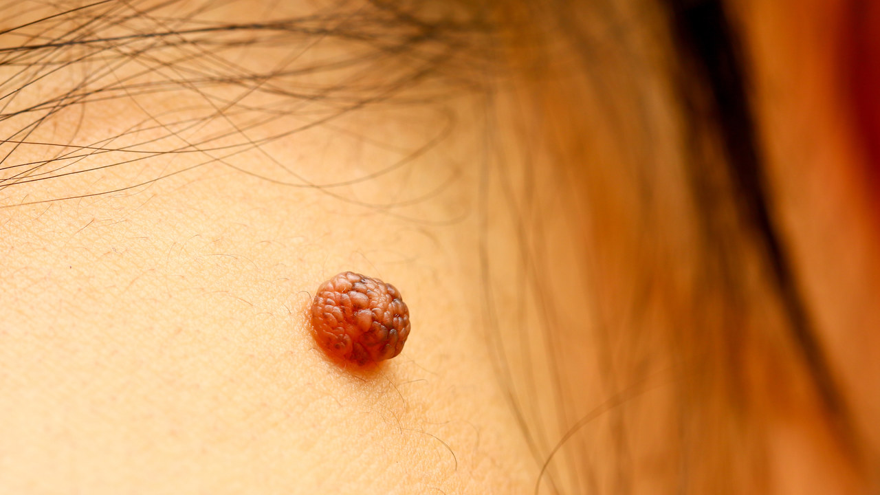 皮肤上的小肉球、小肉疙瘩是什么？不出意外，这4种可能性较大