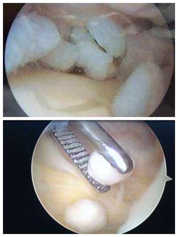 走路关节咔咔响,像有东西卡住一样,小心,可能有只"小老鼠"