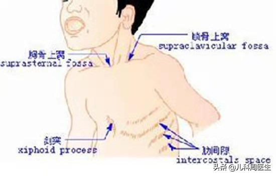 春季，不可轻视的犬吠样咳嗽、声嘶、喉鸣，预示着孩子喉炎高风险