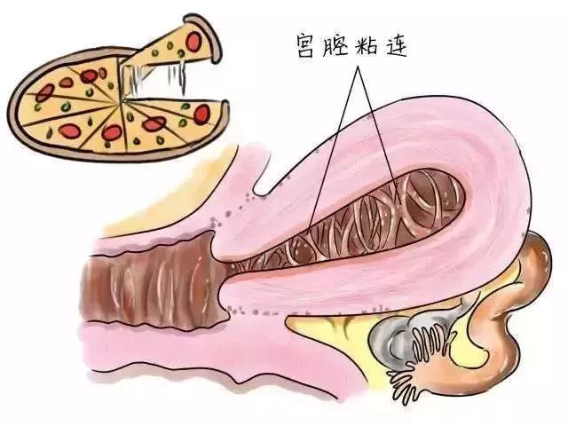 宫腔分离是什么原因引起的？