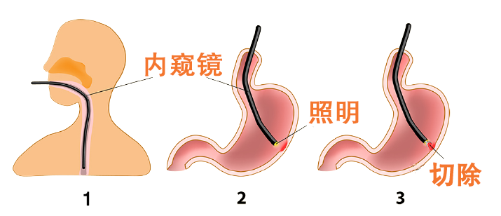 胃镜结构示意图图片
