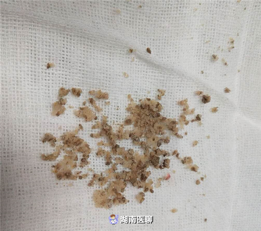 男童膀胱结石反复尿频尿痛还血尿，医生“激光”碎石一次取净