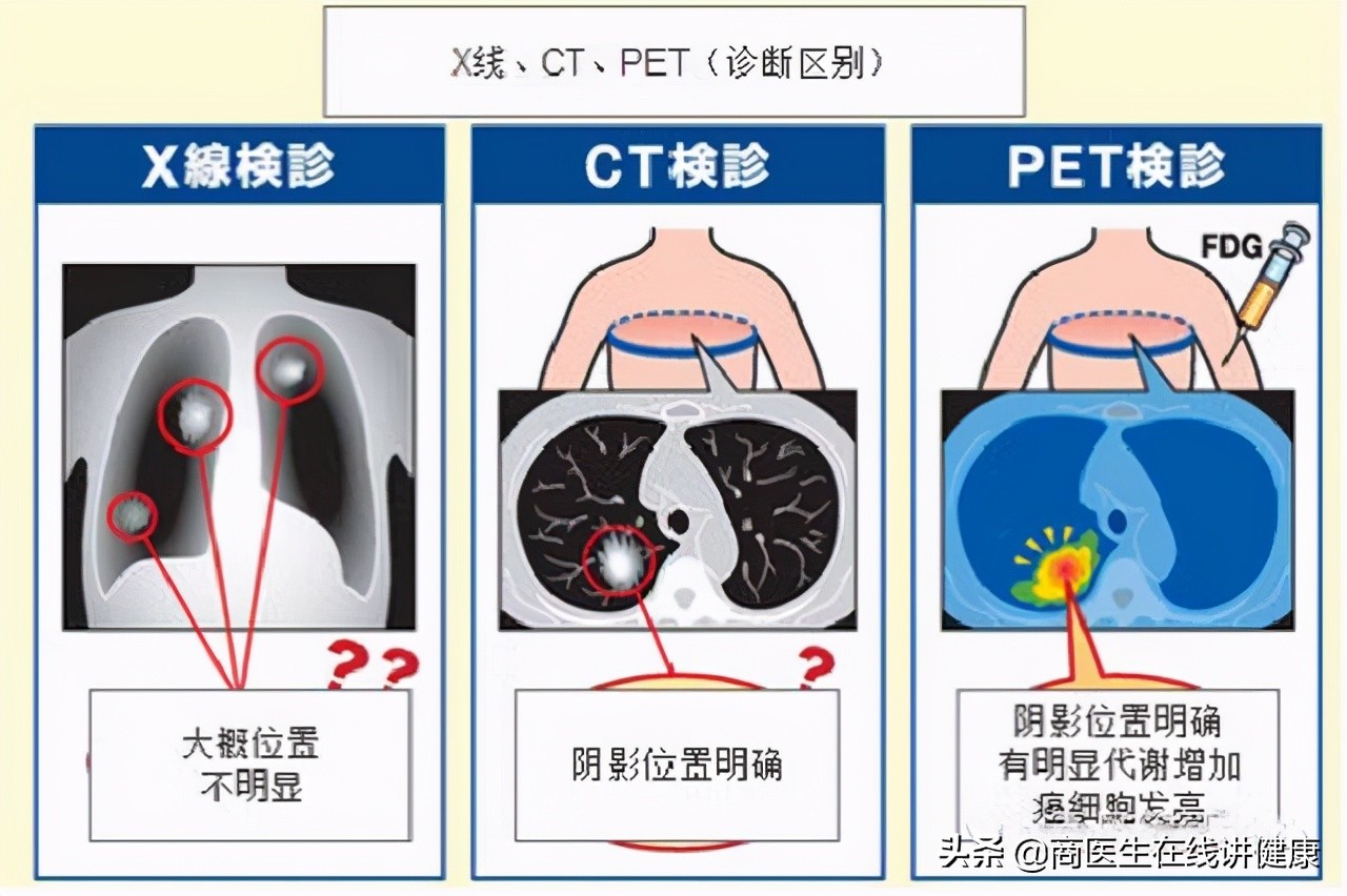 1万一次的PET-CT是什么？值得做吗？