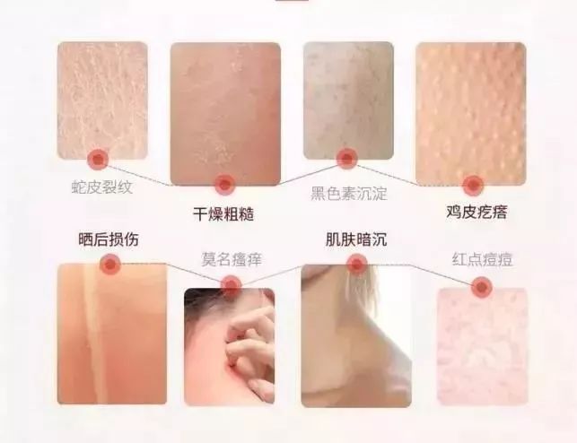 寒冬脸部干燥脱皮严重怎么办？简单4招有效缓解