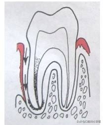 牙齿疼痛难忍口腔医生诊断牙髓炎，牙髓炎症可以消炎治疗吗？