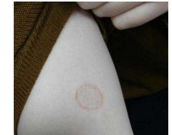 铜钱癣的症状及图片(猫咪得了猫癣到底该怎么治) - 赤虎壹号