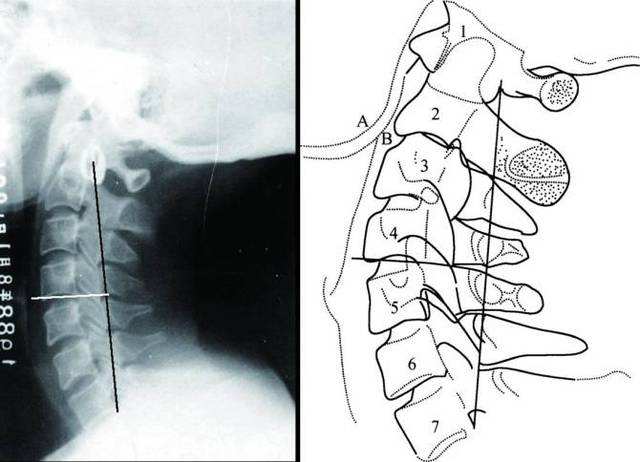 "路医生,拍片说我颈椎「生理曲度变直」是什么意思,严重么?