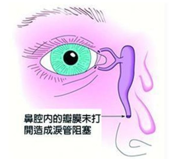 3个月宝宝成天眼泪汪汪？新生儿患泪囊炎，光点眼药水可治不了！