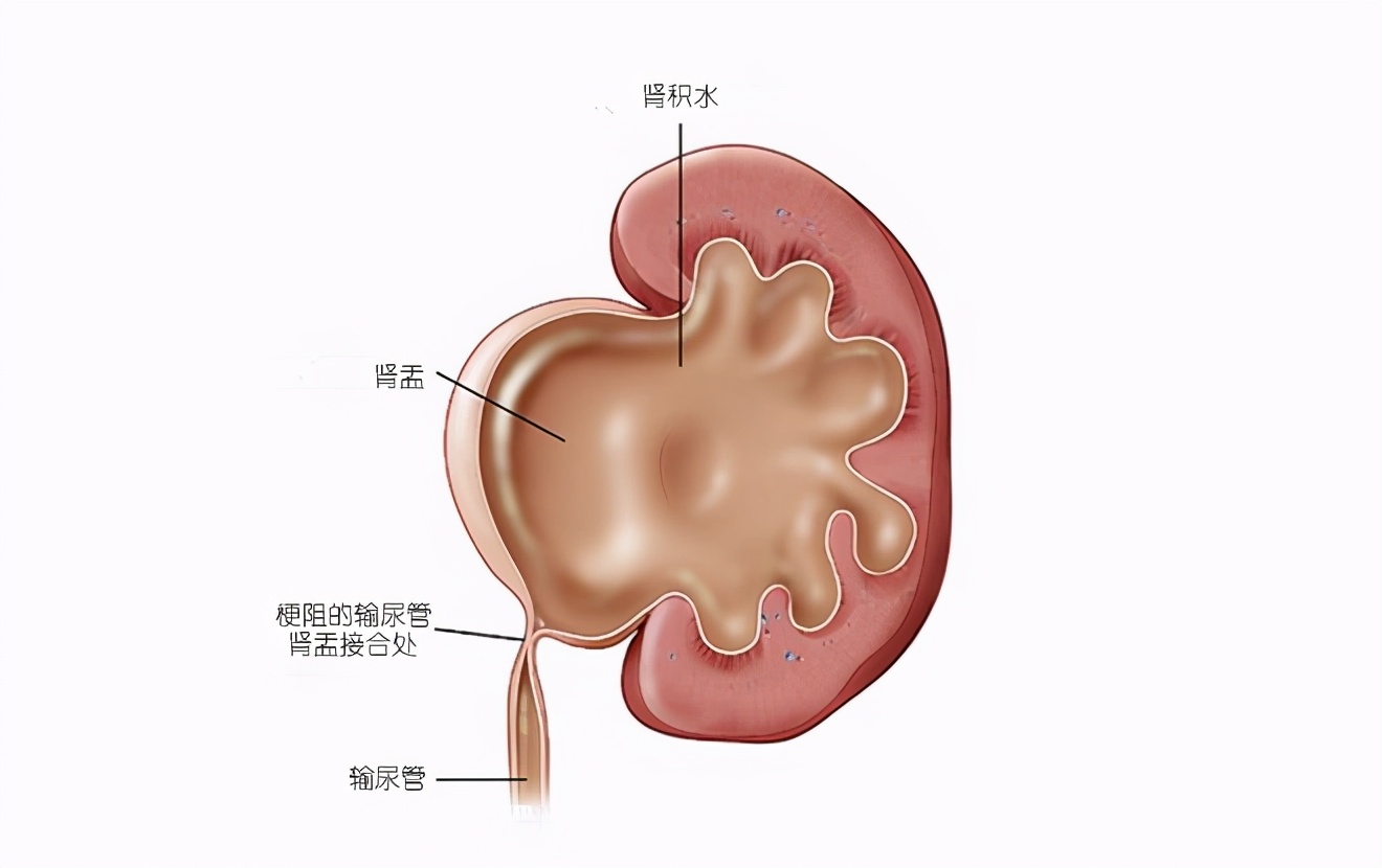 “肾积水怎么办？能不能出一期？”；医生说：关键是要清楚原因