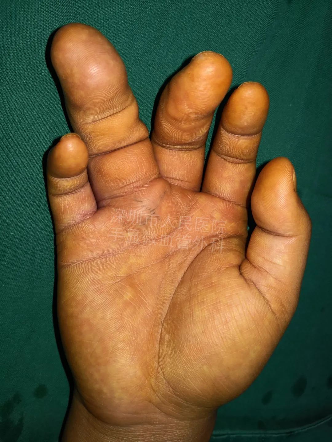 得了这病，12岁男孩手指比香蕉还粗！7种常见的手部畸形，家长们要注意
