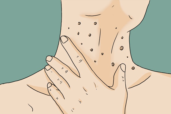 身上长出的“小揪揪”，到底是皮肤病，还是HPV感染？