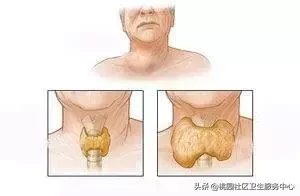 在哪个时段应注意甲状腺危象(一文总结甲状腺危象的识别和急救)