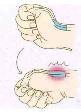 辟谣:手腕疼就是腱鞘炎?还有这种病经常被漏诊,医生告诉你