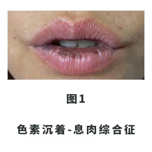 口唇上的黑斑把我送进了手术室......