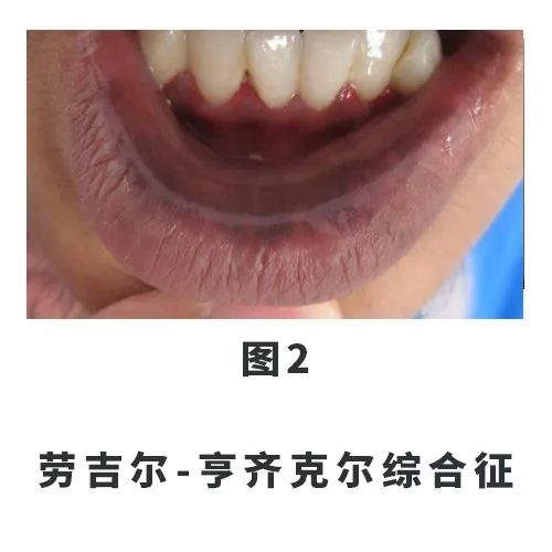 口唇上的黑斑把我送进了手术室......