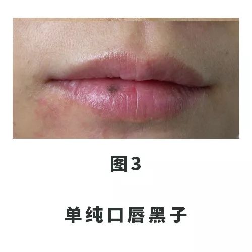 口唇上的黑斑把我送进了手术室......