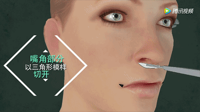 这些项目虽然火，但还是不要做：（3）微笑唇