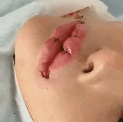 这些项目虽然火，但还是不要做：（3）微笑唇