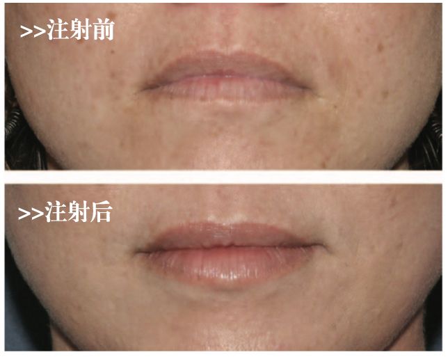 这些项目虽然火，但还是不要做：（3）微笑唇