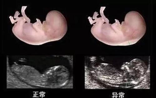 孕12周nt暗示男女(孕12周nt暗示男女知乎)