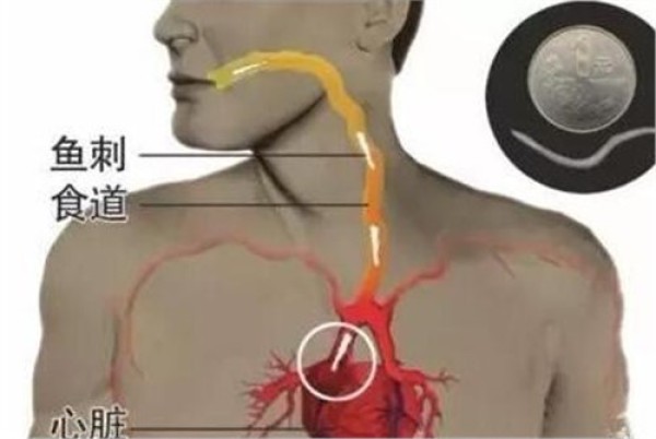 鱼刺卡在喉咙怎么办最有效的办法(鱼刺卡住喉咙的急救方法！竟然90%的人不知道)