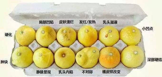 乳腺导管扩张症的形成原因及治疗方法