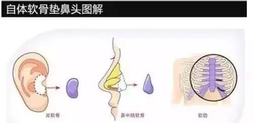 详述：硅胶、膨体、自体软骨、玻尿酸隆鼻优缺点