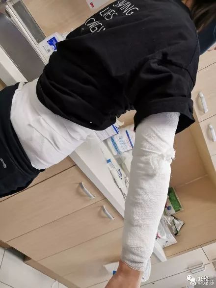 深二度烧伤,深二度烧伤一般多久可以恢复