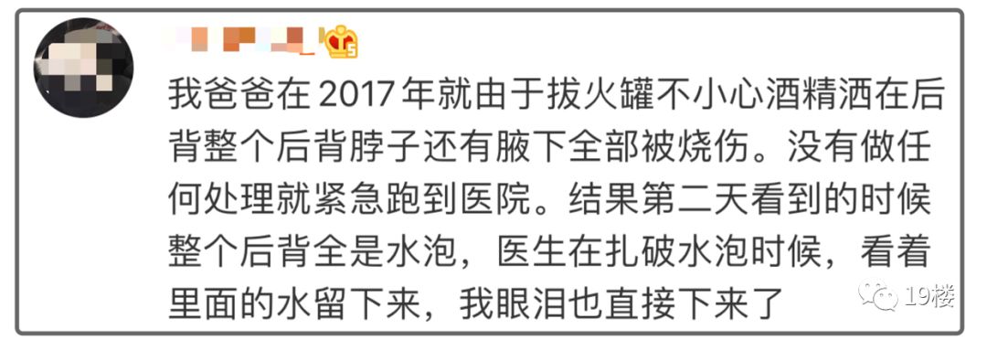 深二度烧伤,深二度烧伤一般多久可以恢复
