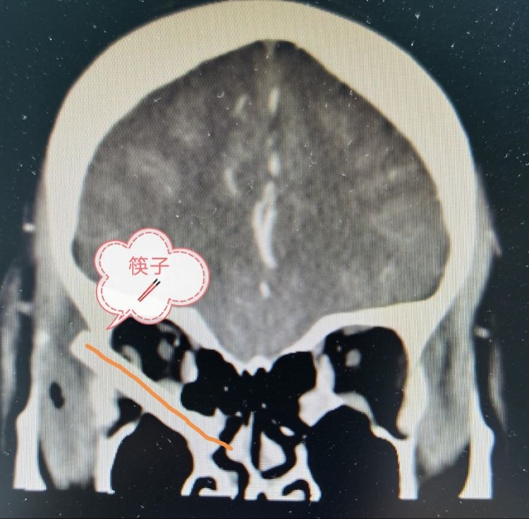 熊孩子玩筷子插入妈妈脑内7厘米，广州医生上演紧急救援