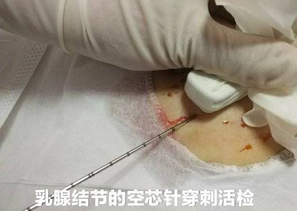 乳腺结节手术费用大概多少钱济南乳腺病医院辟谣