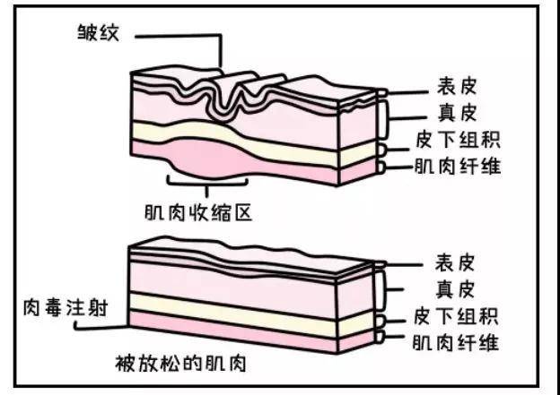 针对眉间去皱纹，分享一个非常简单的去皱纹方法