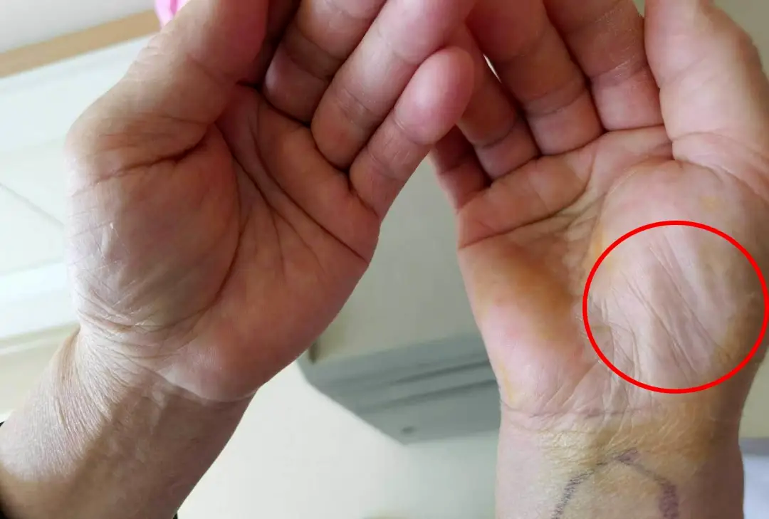 鼠标手怎么引起的鼠标手用什么鼠标好