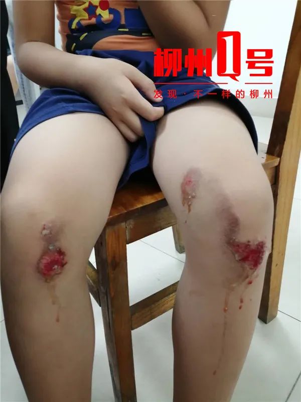 柳州10岁男孩上学路上被狗狂追,摔伤膝盖走路困难!狗主人说...