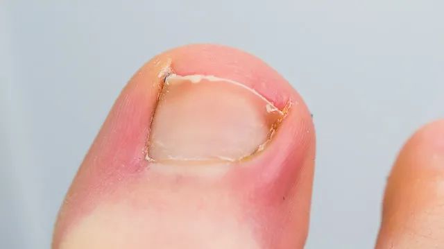轻度甲沟炎初期照片甲沟炎反复发作详解
