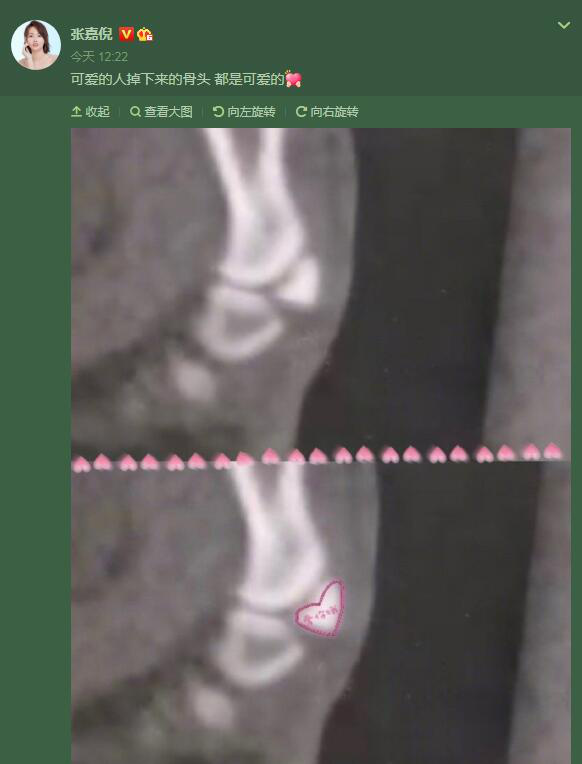 张嘉倪晒X光片：可爱的人掉下来的骨头都是可爱的