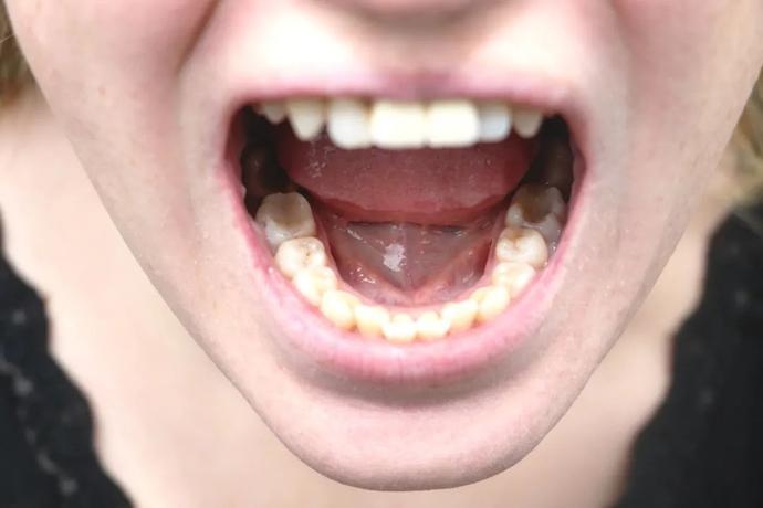 舌头上有白色苔藓是怎么回事舌头上有白可能是口腔癌早期信号