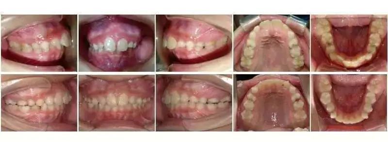 “看不见的牙套”让孩子绽放自信笑容 儿童医院率先推出乳牙期患儿“隐形矫治”