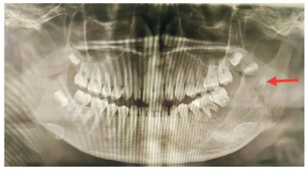 5岁宝宝拔牙致死亡，8岁女孩因牙致脑内脓肿！牙齿千万不能乱来