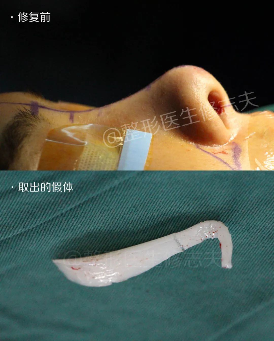 假体隆鼻多少费用(鼻子换假体多少钱) - 读书笔记