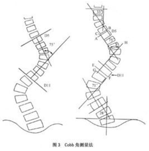 想要孩子挺直腰杆，结果却脊柱侧弯怎么办？