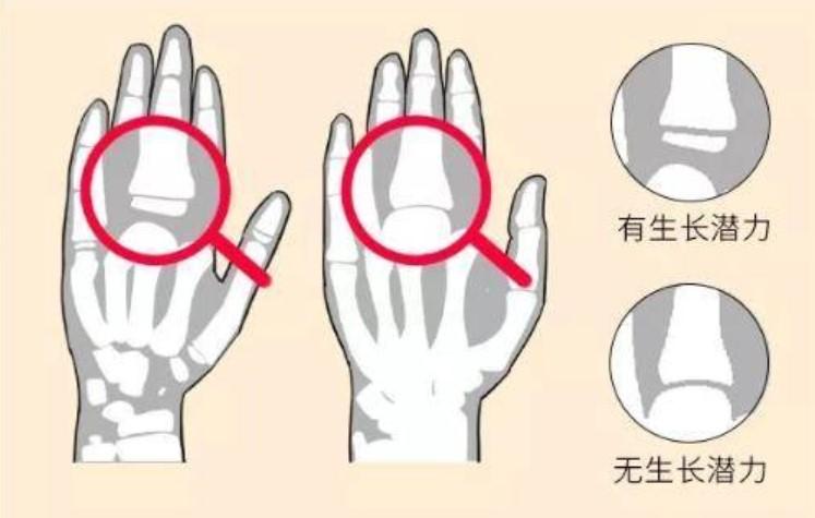 深圳父亲不忍儿子遭罪拒打增高针，医生：盲目注射风险大