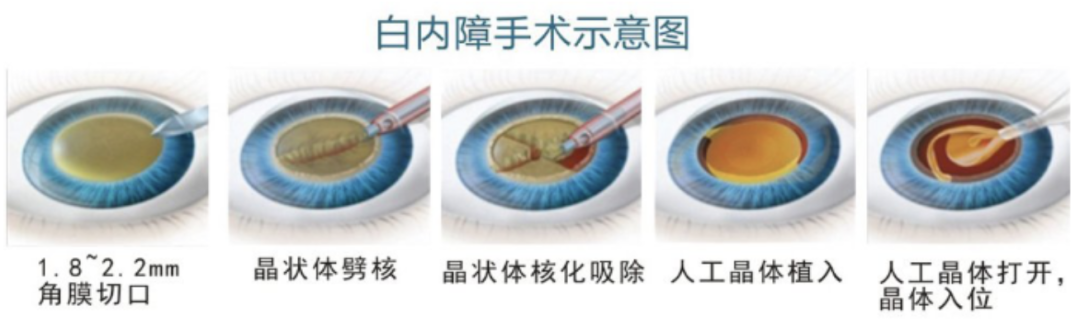 关爱老人|眼睛看不清了，可以自己直接买眼药水滴吗？