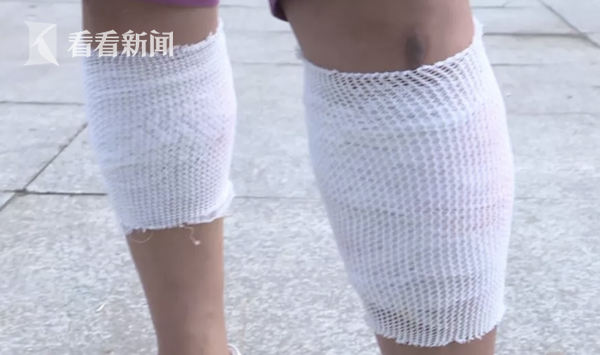 三度烧伤,三度烧伤是什么程度