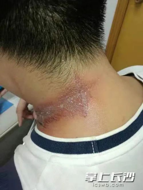 长沙一小区多名业主被“黑虫”毒伤，有医院7天接诊百余例！医生：千万别用手拍