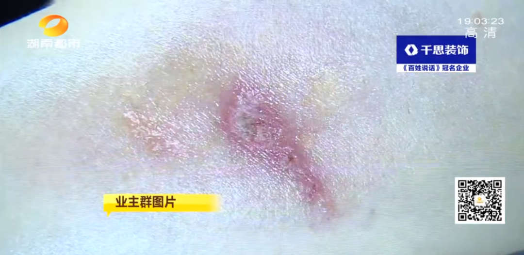 长沙一小区多名业主被“黑虫”毒伤，有医院7天接诊百余例！医生：千万别用手拍